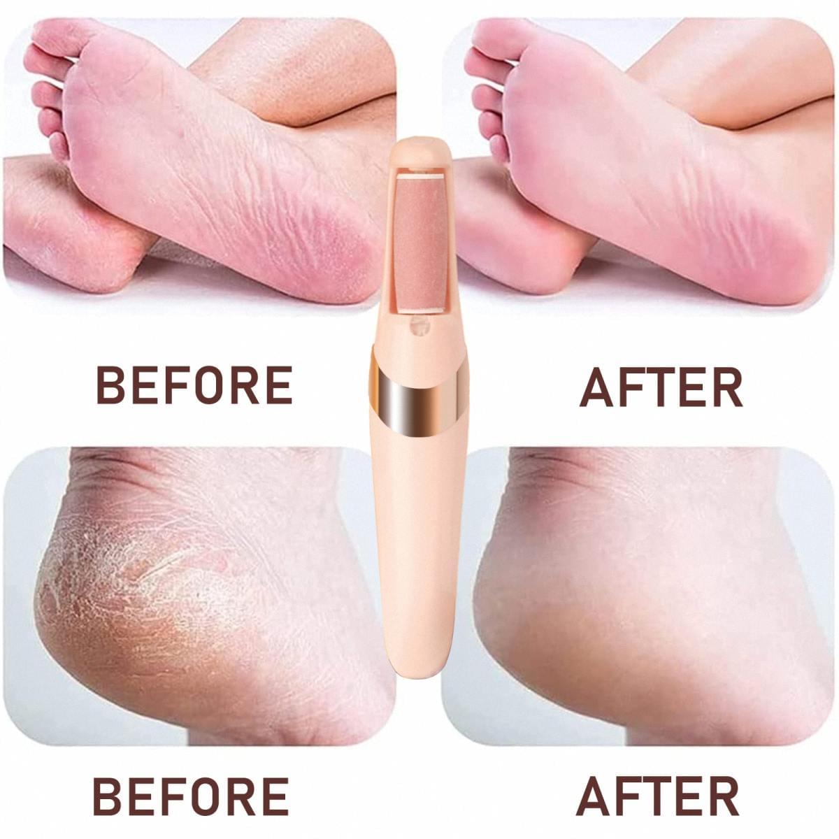 Electronic Tool File and Callus Remover for Fabulous Foot Care